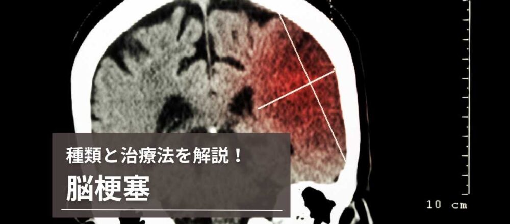 脳梗塞 症状