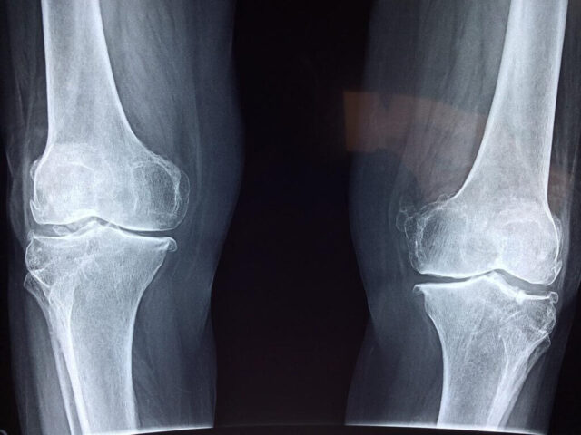 変形性膝関節