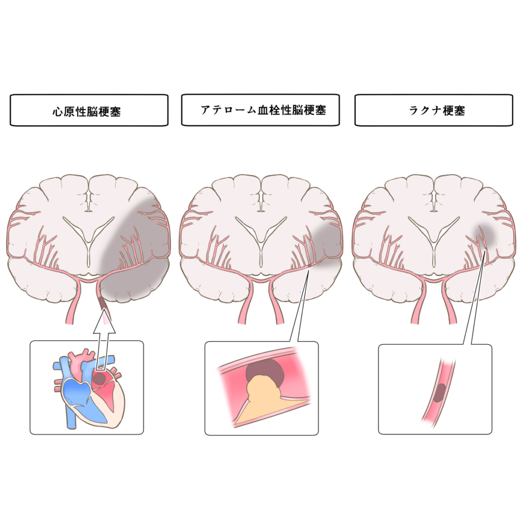 脳梗塞の種類