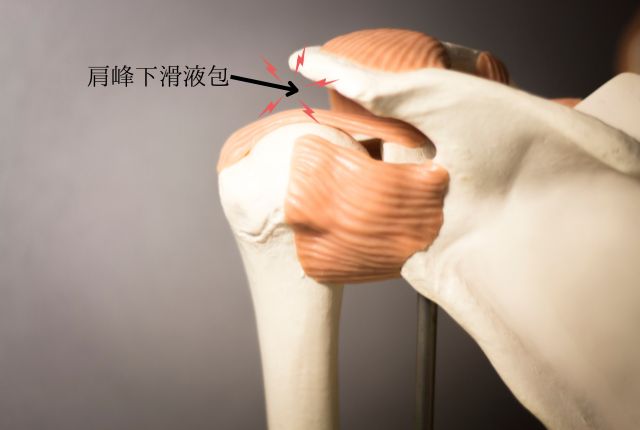 腸腰筋滑液包炎の合併症